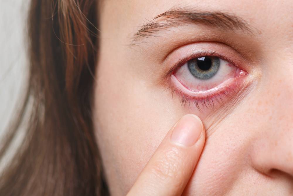 Red Eye