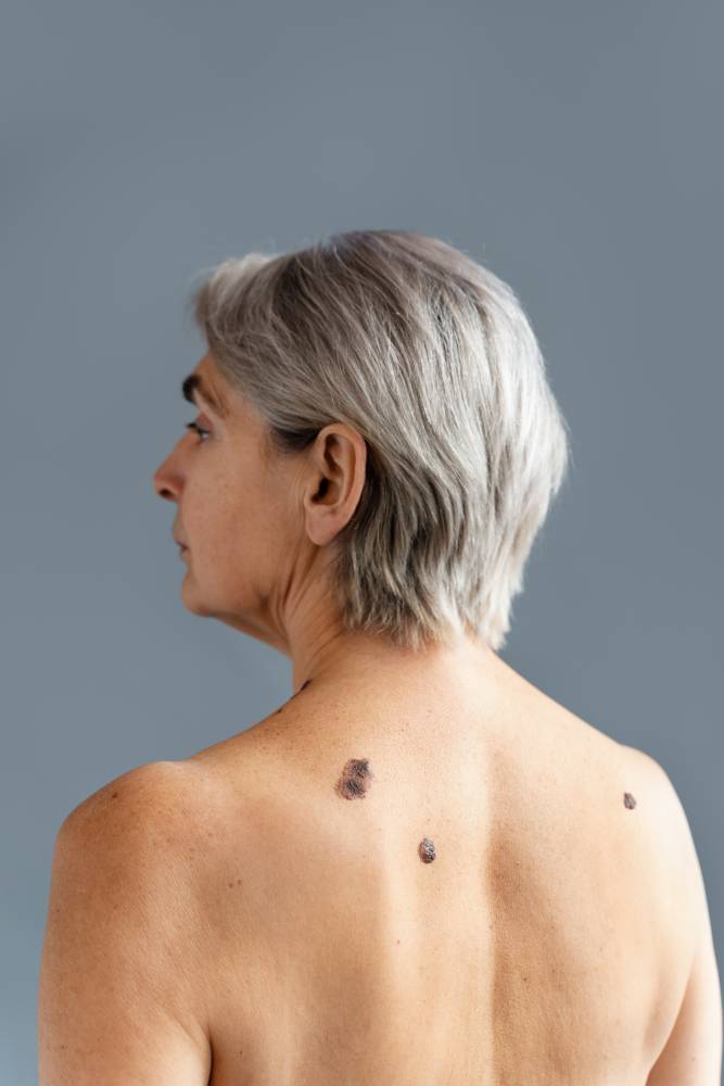 Understanding and Managing Skin Lesions and Cancers in the Elderly